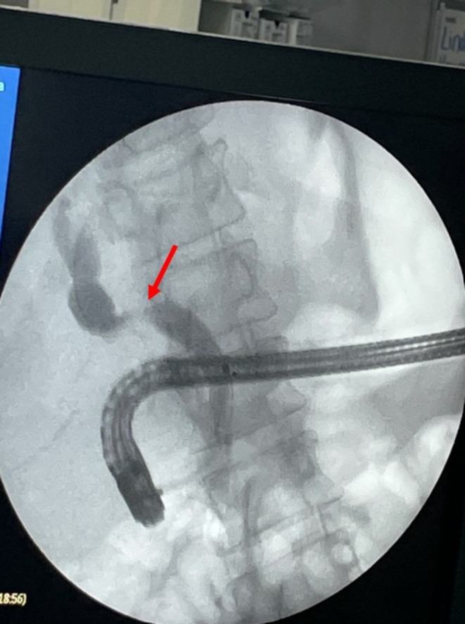 A short, tight anastomotic stricture (red arrow) was identified and a 10 cm 7fr plastic stent was placed across it. Red arrow, anastomotic stricture.