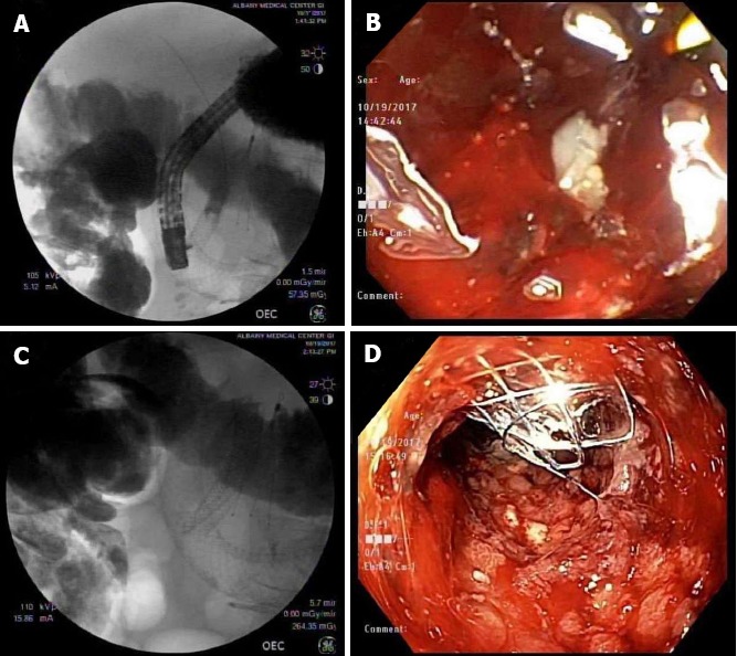 Endoscopic retrograde cholangiopancreatography to place a subsequent 2nd common bile duct stent through an existent duodenal stent. A: CBD BMS and duodenal prosthesis (SEMS) visualized on the 2nd ERCP before inserting the CMS into the CDB; B: Endoscopic visualization of the papilla site filled with debris and tumor invasion; C: CMS deployed on the existing BMS in the CBD through the SEMS in the duodenum; D: Endoscopic visualization of the CBD stent protruding through the papilla in the 2nd portion of duodenum after the completion of the 2nd ERCP. CBD: Common bile duct; BMS: Bare metal stent; SEMS: Self expanding metal stent; CMS: Covered metal stent; ERCP: Endoscopic retrograde cholangiopancreatography.