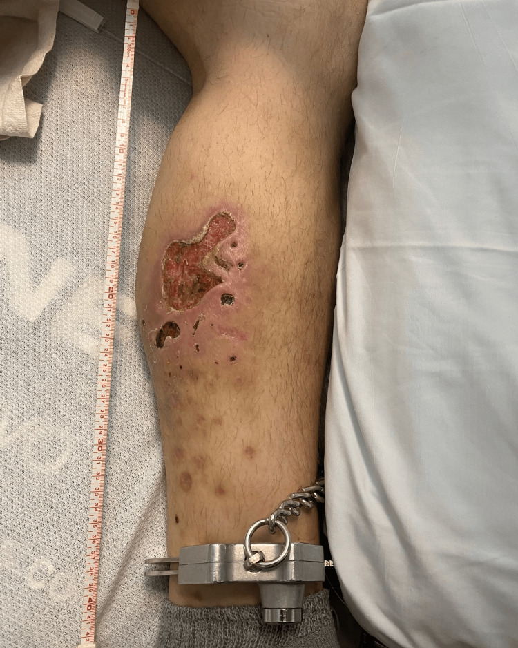 Xylazine-induced necrotic skin ulcerations along the left posteromedial lower leg with associated erythema.