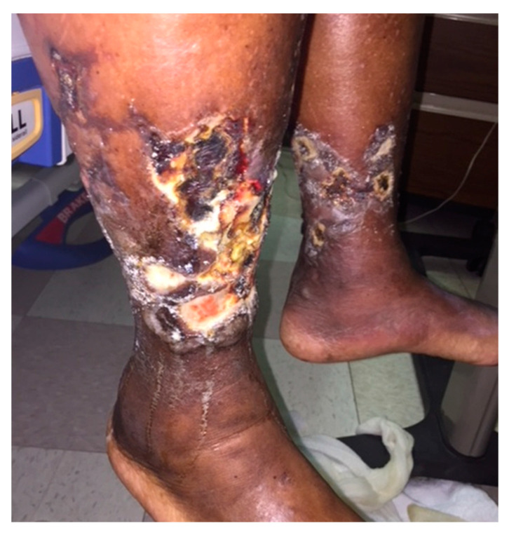Chronic venous insufficiency causes extensive and prolonged ulceration in the gaiter region of both legs. This patient has a severe form of the condition and eventually succumbed to complications related to this.