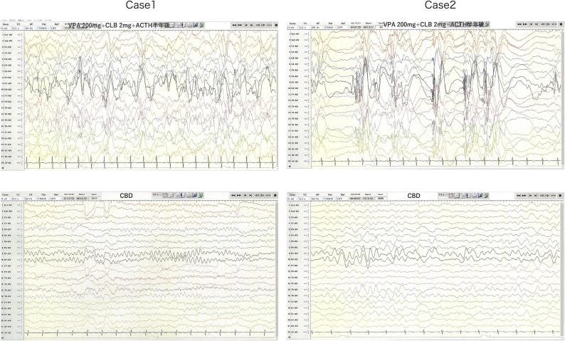 Electroencephalogram (EEG) before and after treatment Upper left: Case 1 (at 269 days old). Irregular bilateral wide-amplitude high-amplitude slow waves emerge, which are intermixed with non-rhythmic and asynchronous spiky waves. Lower left: Case 1 (at 770 days old). The EEG displays predominantly low to moderate amplitude theta waves. The occurrence of interictal epileptiform discharges has been significantly reduced. Upper right: Case 2 (at 269 days old). High-amplitude slow waves and spiky waves appear independently, without a discernible rhythm, and asynchronously. Lower right: Case 2 (at 770 days old). Following CBD treatment, the occurrence of interictal epileptiform discharges is markedly reduced.