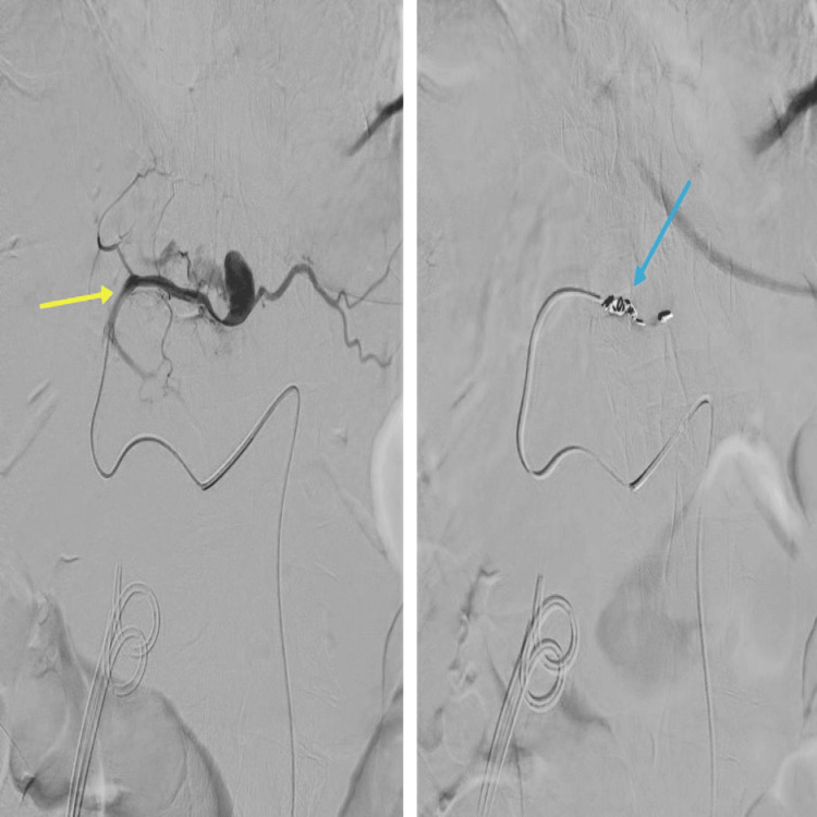 (A) Selective left hepatic angiogram along the feeding vessel with pseudoaneurysm (yellow arrow). (B) Hepatic arteriogram showing successful coil embolization of the segmental branch of the hepatic artery along segment 2 of the liver with 4 mm coils with no filling defects post-embolization (blue arrow).