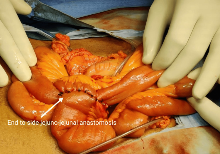 Anastomosis between the duodenum and common bile duct