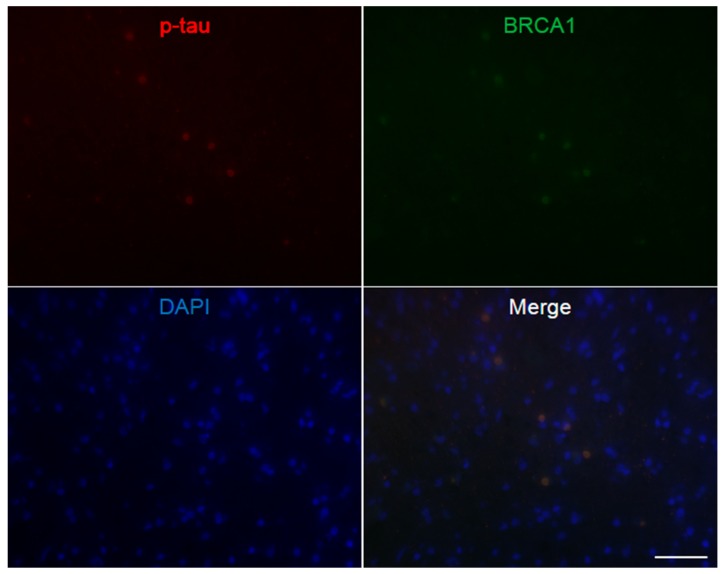 Immunofluorescence double staining of Pick’s disease frontal cortex. Multiple p-tau positive Pick bodies are seen, which all show colocalization of BRCA1. The DAPI positive nucleus may be smaller than cortices of other diseases, possibly due to the decrease in large neurons in this disease [51]. The scale bar represents 50 µm.