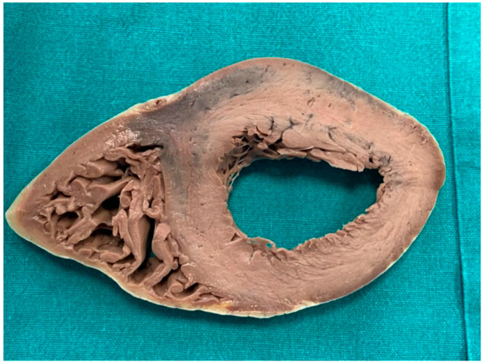 Section of heart after fixation.