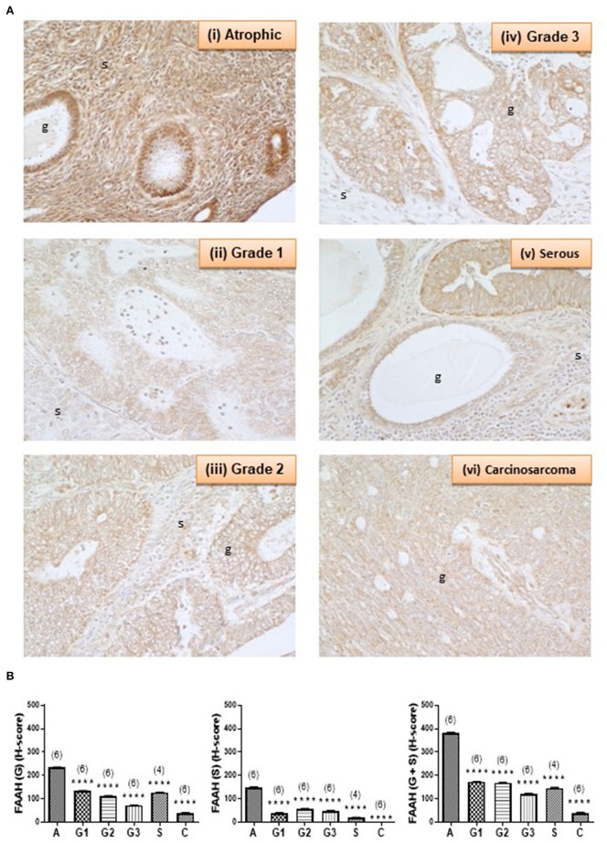 FAAH immunoreactivity decreases in endometrial cancer. (A) Shows representative photomicrographs of immunoreactive FAAH staining in atrophic endometria and grade 1, 2, 3 type 1 EC, and serous and carcinosarcoma type 2 EC. Note the gradual change of staining in the glandular epithelial cells (g) from less to more advanced malignancy. Also note that FAAH immunoreactivity is higher in stromal cells of the atrophic endometrium than in any of the EC tissues, and the presence of cystic glands and normal glands in the serous EC samples. (B) Shows data from the histomorphometric analyses of the glands alone (G, left panel) and stromal tissue alone (S, middle panel) and for the entire tissue (G + S, right panel). The H-scores for FAAH staining was statistically significantly decreased in all the EC when compared to the atrophic endometria. The results are presented as means ± SD, with one way analysis of variance with Dunnett's ad hoc post-test analysis used to determine the p-values; ****p < 0.0001 compared to atrophic; n = 6 in all cases except for serous EC (where n = 4) and numbers are shown in parentheses above each bar. Error bars are not shown when encompassed by the data.