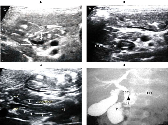 Images of a representative type C of PBM. (A) US transverse scan showed the axial section of both the terminal of the CBD and the PD; (B) US transverse scan showed the axial section of common channel and indicated protein plugs within; (C) US oblique scan showed the terminal CBD and the PD parallel each other and join at the end into the common channel which drains into the duodenum; (D) IOC confirmed dilations of the common channel and the CBD. There is an acute angle (arrow head) of interjunction of the PD and CBD.