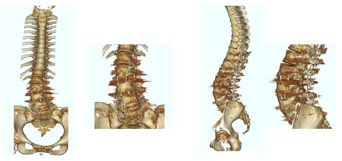 Postoperative 3D CT image of the same patient as in Figure 3. The patient underwent LLIF at L2/3, L3/4, and L4/5 using PEEK cages.