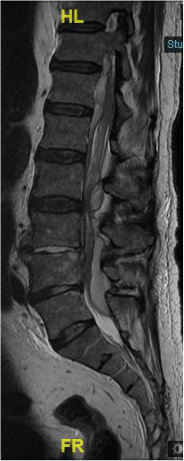Spinal epidural abscess as seen on magnetic resonance imaging of the lumbar spine on day 19 post-endoscopic retrograde cholangiopancreatography