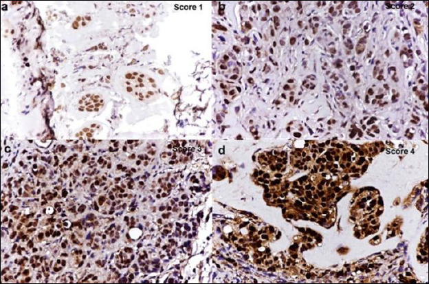 Proliferating cell nuclear antigen expression in tumor cells from mice subcutaneously injected with Michigan Cancer Foundation-7 breast cancer cell line: (a) score = 1, (b) score = 2, (c) score = 3, and (d) score = 4 (counterstained with Mayer’s hematoxylin, 40×).