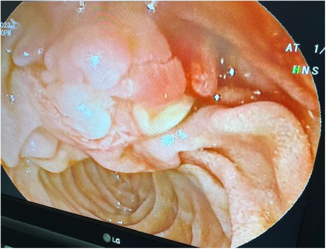 Endoscopic image of the ampulla after stent extraction. The changes observed in the ampulla are due to the long-standing presence of the stent.