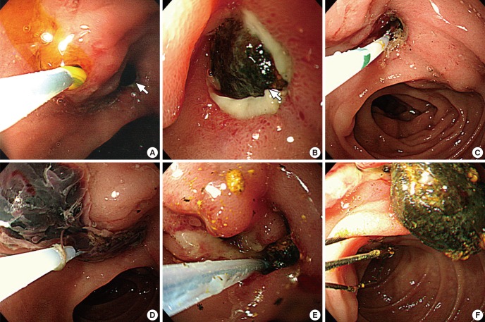 Endoscopic retrograde cholangiopancreatographic findings of enterolith within the periampullary diverticulum (PAD) and its removal. A dark brown pigment stone (white arrow) is seen impacted at the orifice of the PAD (A, B). When the stone is pushed upward into the PAD (C), old blood clots is seen gushing out from the PAD orifice (D). The enterolith within the PAD is being fragmented and removed with Dormia basket (E, F).