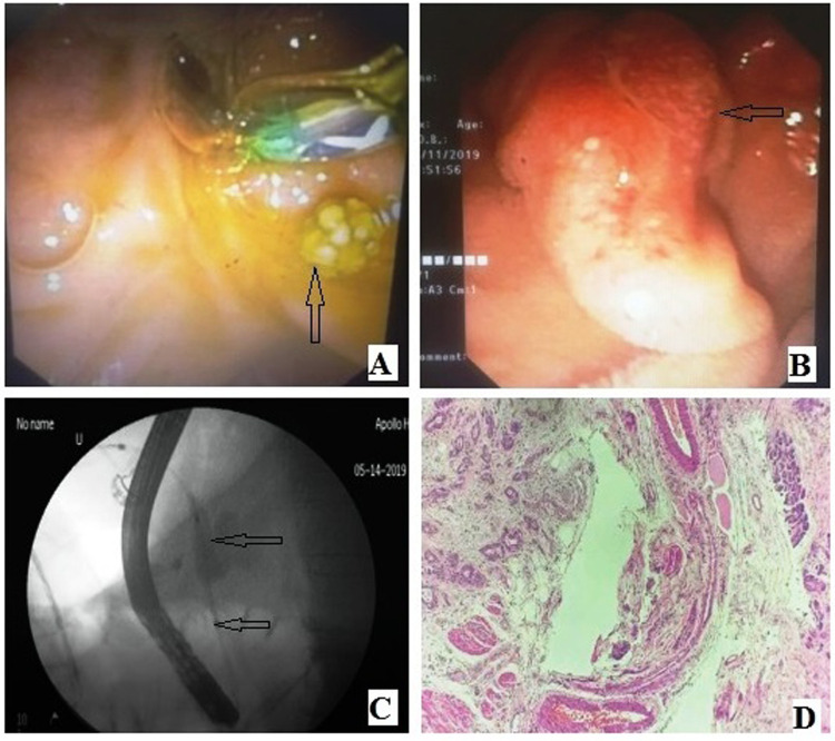 (A) ERCP duodenoscopic image showing CBD calculus. (B) ERCP duodenoscopic image: Periampullary neoplasm. (C) ERCP fluoroscopic image: CBD stricture with dilatation of proximal biliary tree. (D) Haematoxylin and eosin (40×): Periampullary adenocarcinoma at left-hand side and normal pancreatic acini at right-hand side. CBD, common bile duct; ERCP, endoscopic retrograde cholangiopancreatography.