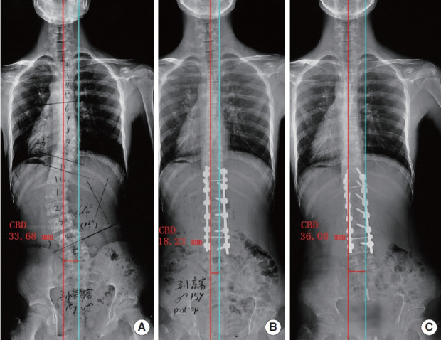 Radiographs of a 15-year-old boy with adolescent idiopathic scoliosis in type C preoperative coronal pattern (A). The coronal balance was improved after surgery immediately (B), but 2 years later, the coronal plane recovered to the primary unbalanced state (C). Type C, coronal balance distance (CBD)≥20 mm and coronal C7 plumbline shifts to the convex side of the curve.
