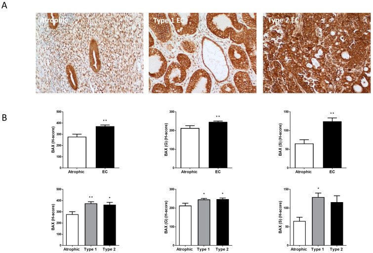 BAX immunohistochemistry staining patterns. Panel (A) shows brown (DAB) staining for BAX in representative sections of control (Atrophic), Type 1 and Type 2 endometrial cancer (EC) tissues. Images were captured at 200× magnification. Staining of both stromal and glandular and luminal epithelial tissue is noted in the control tissue, with slightly higher intensity staining of the stromal compartment. By contrast, overall staining levels in the EC tissues were reduced when compared to the control tissue. Panel (B) shows the histomorphometric analyses for the whole tissue, for the glands (G) alone or the stroma (S) alone. The histoscore (H-score) was significantly reduced in the entire tissue, glands and stroma (top set of graphs) when compared to the atrophic control (** p < 0.01; Student’s t-test). Sub-type analysis of the Type 1 and Type 2 EC samples indicated that overall staining H-score levels in both types of EC tissues were reduced when compared to the control tissue (lower set of graphs), regardless of whether the entire tissue, glands and stroma when compared to the atrophic control (* p < 0.05; ** p < 0.01; one-way ANOVA with Tukey’s HSD test).