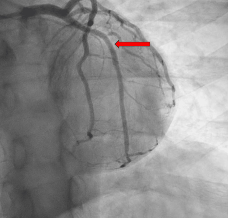 LAO caudal view post-PCI showing the mid-left circumflex artery after the deployment of a 3×20 mm drug-eluting stent (red arrow)LAO: left anterior oblique; PCI: percutaneous coronary intervention