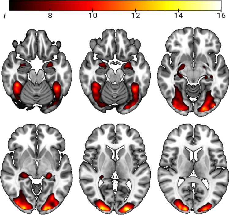 Depiction of brain areas that show higher activation during presentation of emotional face expressions versus geometric shapes in the whole sample (one-sample t-test, contrast: “faces– shapes”, pFWE < 0.05 whole-brain corrected)