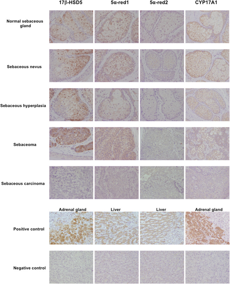 Representative illustration of 17β-hydroxysteroid dehydrogenase 5 (17β-HSD5), 5α-reductase (5α-red)1, 5α-red2 and cytochrome P45017A1 (CYP17A1) immunoreactivity in human sebaceous gland and its disorders.17β-HSD5, 5α-red1 and CYP17A1 immunoreactivity was predominantly detected in normal sebaceous glands compared to pathological sebaceous glands (magnification 200x).