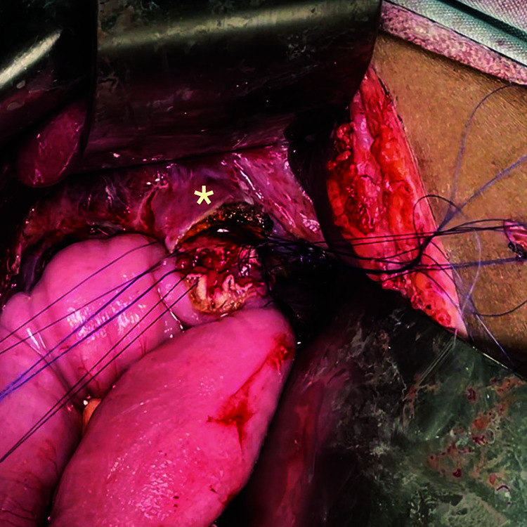 Image showing bilioenteric anastomosis at the proximal stump of the CBD in an interrupted single layer fashion using absorbable sutures (* = proximal stump of the CBD)