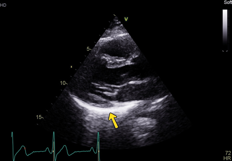 Echocardiogram suggestive of pericarditis