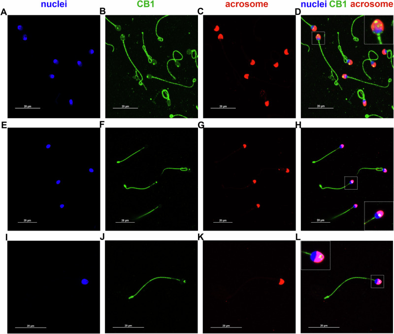 CB1 is present in both the human sperm head and flagellum.Representative confocal images showing CB1 distribution in human sperm, with fluorescence signals (green) detected in the acrosomal (red) and post-acrosomal regions of the head, as well as in a spot-like pattern along the flagellum. Nuclei were counterstained with DAPI (blue). CB1 dots in the acrosomal region appear in yellow, as merge of CB1 (green) and acrosome (red). High-magnification images (white dashed squares) highlight CB1 localization as multiple smaller head spots (A–D, I–L) or as a single larger head spot (E–H). Scale bar: 20 µm.