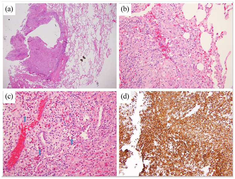 Histologic examination of lung parenchymal cells. (a) Subpleural and parenchymal collections of large cells, mostly located around cystic spaces (hematoxylin and eosin). (b) Cells containing abundant eosinophilic cytoplasm, irregular convoluted nuclei, and grooves (hematoxylin and eosin). (c) Multinucleated giant cells, numerous eosinophils (arrows), and fewer lymphocytes (hematoxylin and eosin). (d) The large lesional cells were positive for CD1a immunohistochemical stain