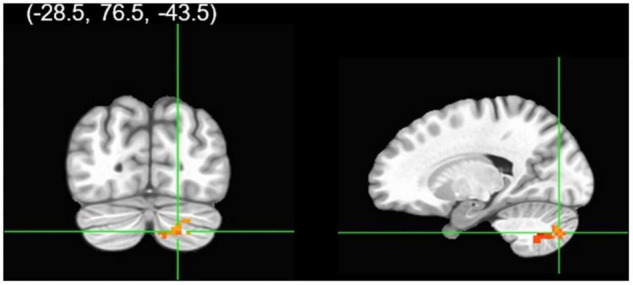 Group analysis of connectivity with the right rACC during correct calm No-go trials. A gender group contrast revealed the right rACC had greater functional connectivity with a cluster in the right cerebellum in males relative to females. The colors represent areas of significant connectivity; warm colors indicate increased connectivity (voxelwise threshold p < 0.005; family-wise correction p < 0.05).