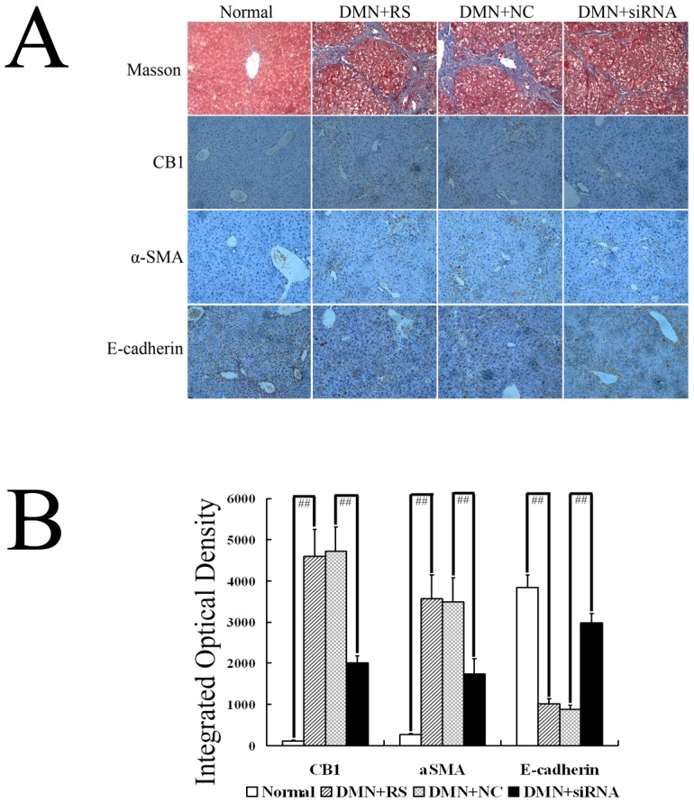 Effect of CB1-RNAi-LV on hepatic fibrosis and epithelial- mesenchymal transitions in livers of DMN rats.(A) The first line showed the representative graph of Masson's trichrome staining (magnification of 20×) in normal rats (Normal), rats with DMN treatment and Ringer's solution injected (DMN+RS), rats with DMN treatment and NC-LV injected (DMN+NC-LV), rats with DMN treatment and CB1-RNAi-LV injected (DMN+RNAi-LV). The second, the third and the fourth line showed the representative graph of CB1, α-SMA and E-cadherin immunohistochemical examination (magnification of 20×) in normal rats (Normal), rats with DMN treatment and Ringer's solution injected (DMN+RS), rats with DMN treatment and NC-LV injected (DMN+NC-LV), rats with DMN treatment and CB1-RNAi-LV injected (DMN+RNAi-LV). (B) Shows statistical results of CB1, α-SMA and E-cadherin immunohistochemical staining. Masson's trichrome staining of liver sections in the DMN rats and the NC-LV treatment rats showed periportal fibrosis with short septa extending into lobules or porto-portal septa, and severe cholestasis and bile duct hyperplasia were also observed, whereas hepatic fibrosis was significantly ameliorated in the CB1-RNAi-LV treatment rats as compared with the NC-LV treatment rats. Immunohistochemical examination revealed that CB1 and α-SMA protein expressions increased significantly in the DMN rats, which were suppressed by CB1-RNAi-LV treatment. Immunochemical examination also showed that DMN treatment declined E-cadherin expression significantly compared with normal rats, while E-cadherin expression elevated significantly in DMN rats transfected with CB1-RNAi-LV, compared with that in DMN rats transfected with NC-LV. “# #” p<0.01.