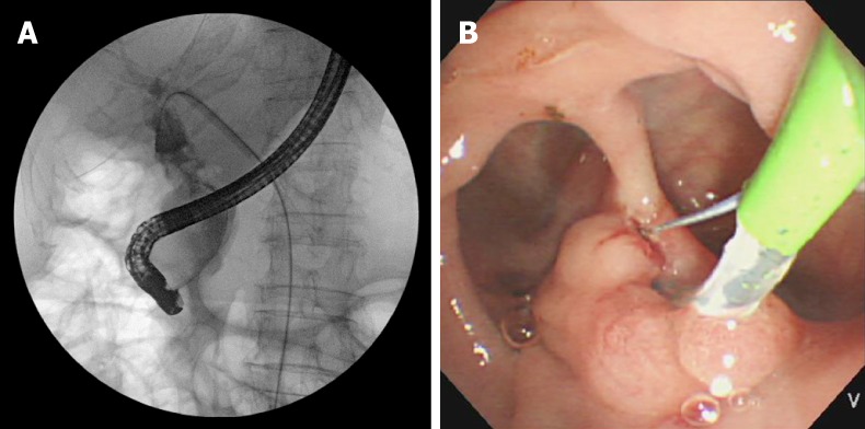 Images of endoscopic retrograde cholangiography and endoscopic sphincterotomy with rendezvous technique. A: Cholangiography image of endoscopic retrograde cholangiography with rendezvous technique; B: Endoscopic image of endoscopic sphincterotomy. Large periampullary diverticula surrounding the papilla of Vater.
