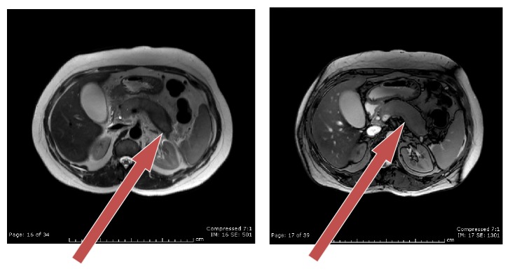 MRCP images arrow showing sausage-like pancreas in delayed phase.
