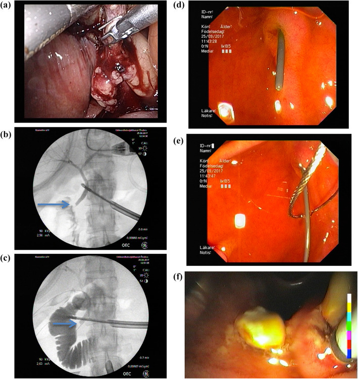 ERCP with Rendezvous technique: a cholangiography tube in the cystic duct; b cholangiography confirming distal CBD stone (arrow); c cholangiography with guidewire in place; d guidwire in place (Ampulla of Vater); e guidwire caught by endoscopist; f extraction of CBD stones by balloon clearance