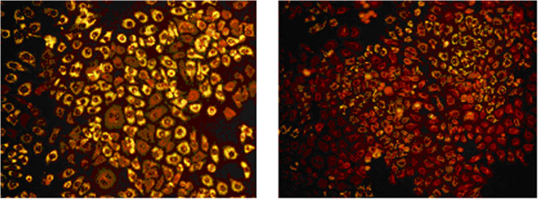 Fat accumulation in HepG2 liver cell. Fat accumulation rate in the HepG2 fatty liver cells was 52.1 ± 5.2%, while the rate in control group was 15.3 ± 6.6% (p < 0.05). HepG2 fatty liver cell; HepG2 liver cell.