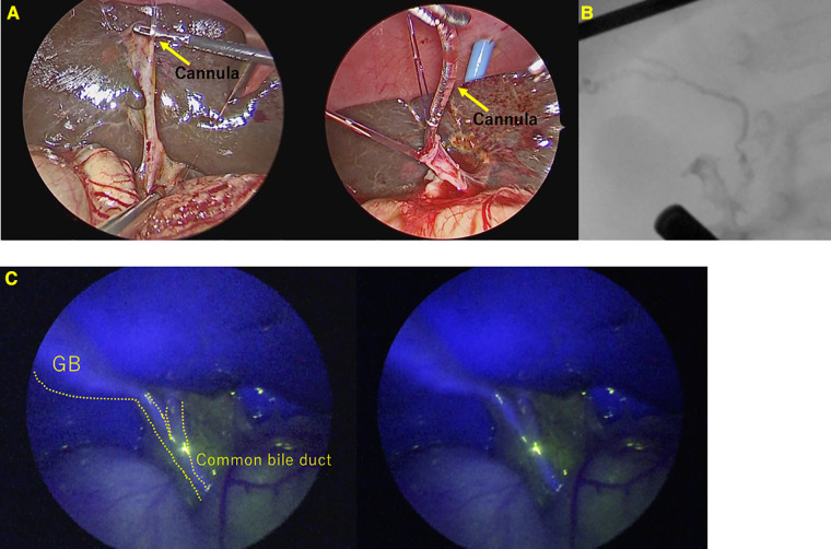 A case of Alagille syndrome requiring cholecystectomy after contrast due to difficulty in contrast from an atrophic gallbladder. (A) Cannulation into the gallbladder was difficult and took many attempts. (B) Conventional cholangiography. (C) ICG Fluorescence cholangiography.