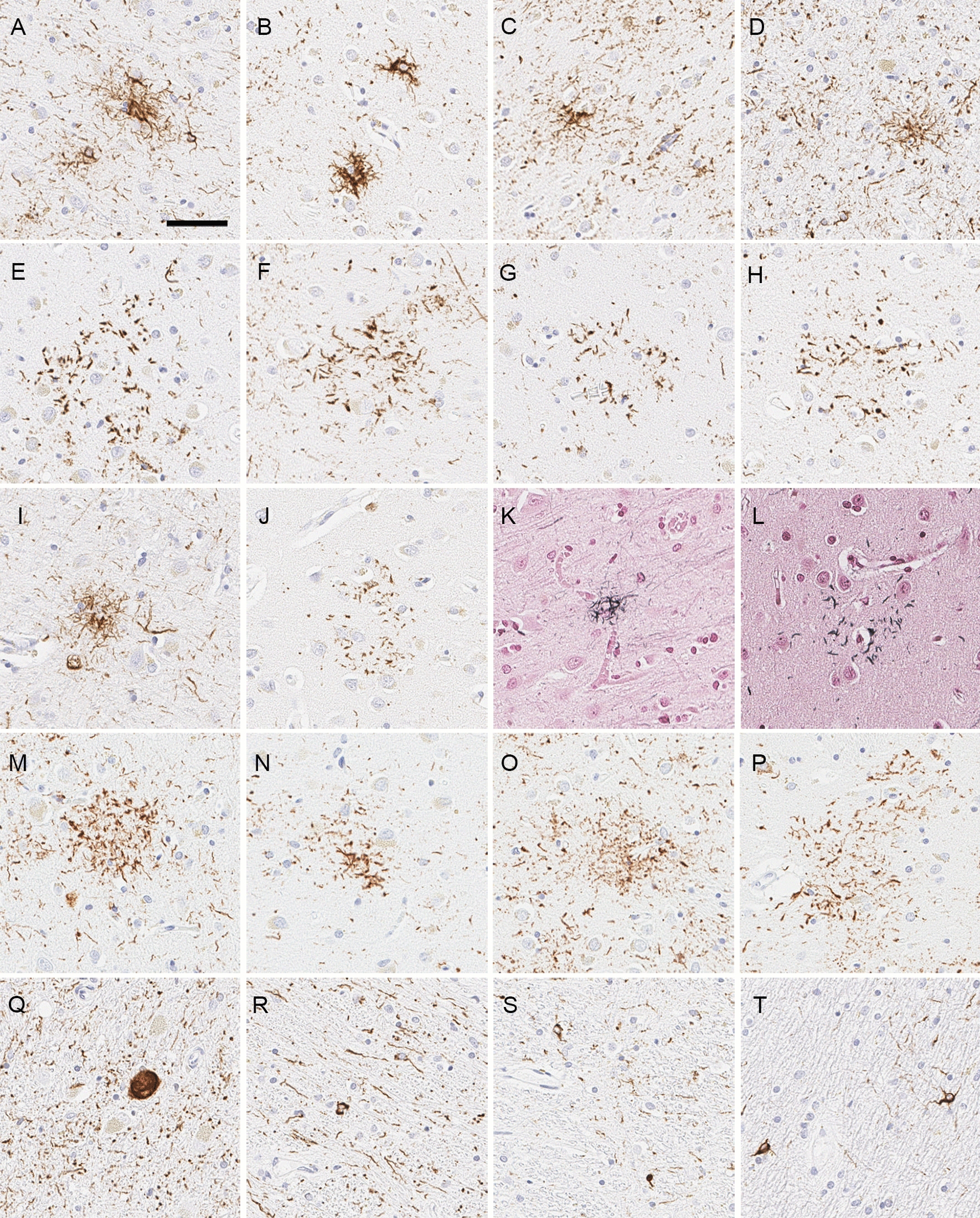 Representative images of histopathological findings of Case 1. A-H Immunohistochemistry for CP13 shows tufted astrocytes in the motor cortex (A), putamen (B), caudate nucleus (C), and midbrain tegmentum (D), as well as astrocytic plaques in the superior frontal gyrus (E), entorhinal cortex (F), occipitotemporal cortex (G), and putamen (H). I, J Immunohistochemistry for 4-repeat tau (RD4) reveals tufted astrocyte in the motor cortex (I) and astrocytic plaque in the superior frontal gyrus (J). K, L Gallyas silver staining shows tufted astrocyte in the motor cortex (K) and astrocytic plaque in the superior frontal gyrus (L). N-P There are astrocytic tau lesions that are categorized neither astrocytic plaques nor tufted astrocytes. Q-T Immunohistochemistry for CP13 shows globose tangles in the subthalamic nucleus (M); coiled bodies and threads in the thalamic fasciculus (N), red nucleus (O), and cerebellar white matter (P). Scale bar = 50 μm