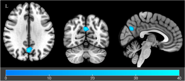 Whole brain analysis visualisation. Cluster hypoactivation across Alcohol and Neutral cues when comparing CBD to Placebo. Colour bar indicates F-values with cooler colours indicating increasing hypoactivation