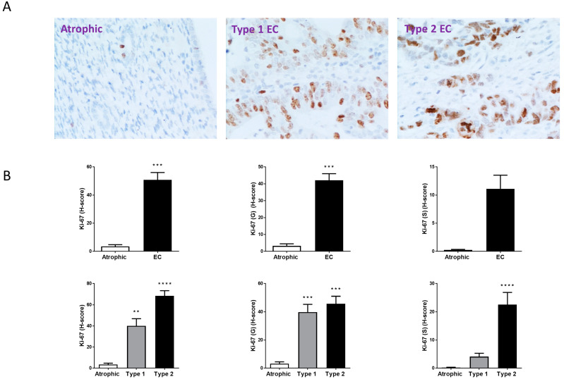 Ki-67 immunohistochemistry staining patterns. Panel (A) shows brown (DAB) staining for Ki-67 in representative sections of control (Atrophic), Type 1 and Type 2 endometrial cancer (EC) tissues. Images were captured at 200× magnification. Staining of both stromal and glandular and luminal epithelial tissue is noted in the control tissue, with slightly higher intensity staining of the stromal compartment. By contrast, overall staining levels in the EC tissues were reduced when compared to the control tissue. Panel (B) shows the histomorphometric analyses for the whole tissue, for the glands (G) alone or the stroma (S) alone. The histoscore (H-score) was significantly reduced in the entire tissue, glands and stroma (top set of graphs) when compared to the atrophic control *** p < 0.001; Student’s t-test). Sub-type analysis of the Type 1 and Type 2 EC samples indicated that overall staining H-score levels in both types of EC tissues were reduced when compared to the control tissue (lower set of graphs), regardless of whether the entire tissue, glands and stroma when compared to the atrophic control (** p < 0.01; *** p < 0.001; **** p < 0.0001; one-way ANOVA with Tukey’s HSD test).