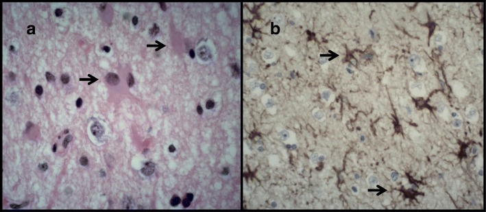 Astrocytic gliosis. (a) H&E and (b) glial fibrillary acid protein (GFAP) stained sections demonstrate marked astrocytic gliosis characterised by an evenly dispersed proliferation of large reactive astrocytes with abundant eosinophilic cytoplasm and branching processes (arrows)
