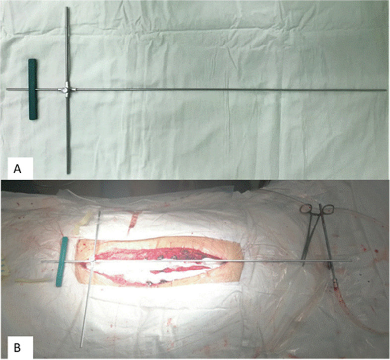 a Inverted cross device (upper body part aligner) and (b) being aligned on a patient