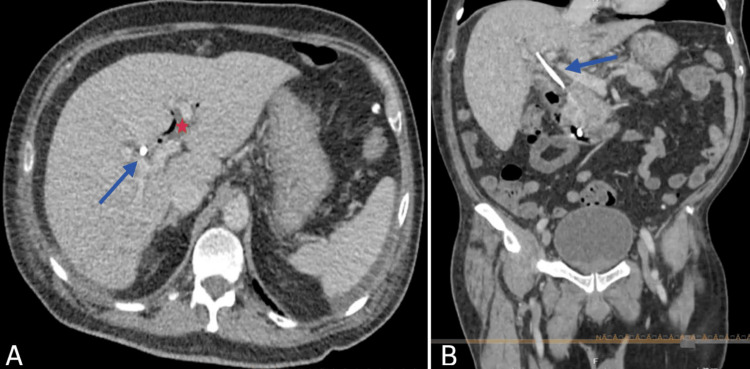 Non-contrast abdominopelvic CT scan.(A) Axial view: The gallbladder is not visualized. The blue arrow indicates hyperdense material within the common bile duct, corresponding to biliary diversion surgical material. The asterisk denotes pneumobilia.(B) Coronal reconstruction: The gallbladder remains absent. The blue arrow highlights a linear hyperdense structure within the bile duct lumen, extending distally toward the second portion of the duodenum. No associated fluid collections are observed.