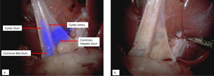 Swine #1—Images of the extra-hepatic biliary tree during the second surgery with (a) and without (b) BL-760 overlay