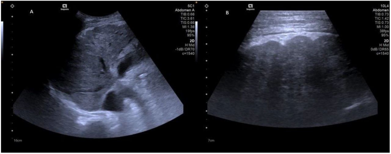 Ultrasound images of a liver from a male participant in his 50’s with HCV(A) Curved array low-frequency probe image demonstrating highly coarse echotexture.(B) Linear array probe image showing highly coarse echotexture and highly irregular surface. These findings were categorized as marked morphological change consistent with cirrhotic appearance.