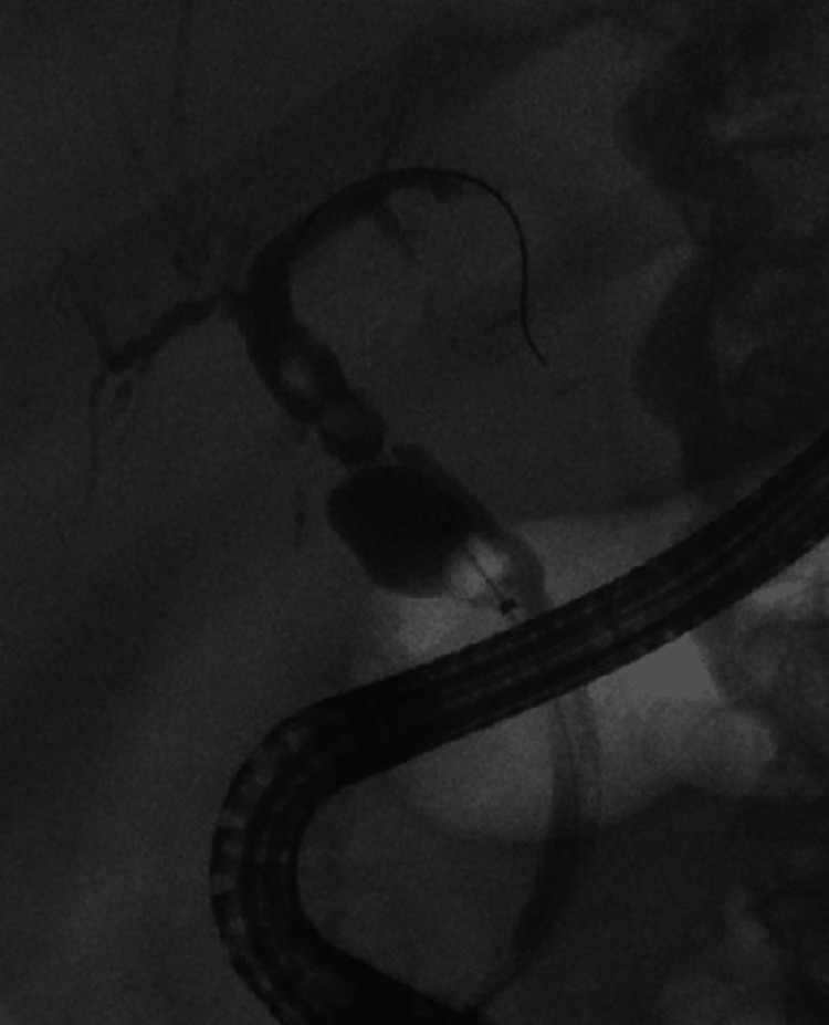Endoscopic retrograde cholangiopancreatography (ERCP) showing filling defects in proximal and distal common bile duct (CBD) along with strictures in duct-to-duct anastomosis and dilatation of cystic stump