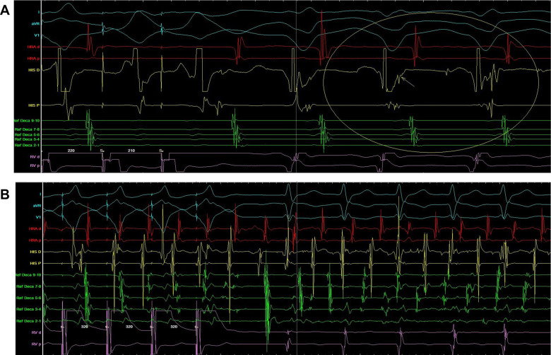 (A) Electrophysiological study of patient 1. Supraventricular tachycardia induced during ventricular pacing (arrow shows concentric activation). (B) Electrophysiological study of patient 1. Supraventricular tachycardia deteriorating to atrial fibrillation during ventricular overdrive pacing.
