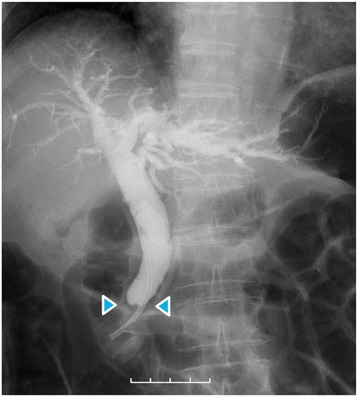Cholangiography demonstrates that CBD was abruptly obstructed in the lower part (blue arrowheads) and was grossly dilated in the proximal part