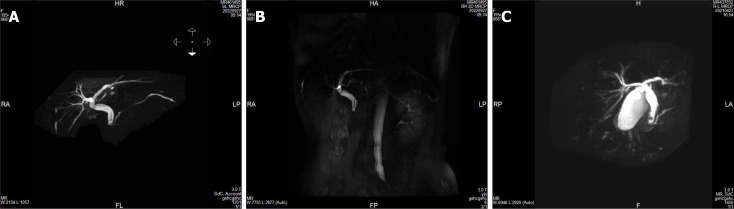 Magnetic resonance cholangiopancreatography showing a low-signal foreign body in the common bile duct (the external shape is similar to a Hem-o-lok clip). A-C: High-density shadow in the common bile duct.
