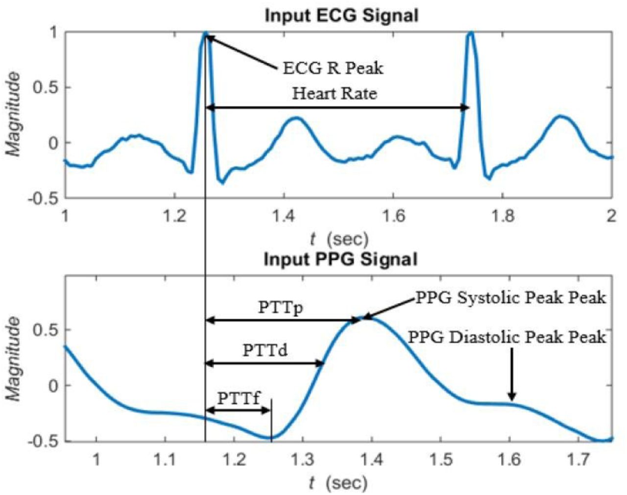 Sample ECG and PPG signal illustrating PPT calculation from R peaks of ECG signal and some point of PPG signal