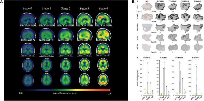 Disease staging with the tau PET tracer [18F]AV1451 and autoradiography with [3H]PI-2620, [3H]MK6240, [3H]RO948, and [3H]JNJ067. (A) Representation of tau PET images labeled with flortaucipir ([18F]AV1451) for staging tau pathology. An increase in SUVR is visible in the cortex and subcortex from stage 0 to 4. Stage 0 represents tau levels of healthy controls. In stage 1, tau levels are elevated in medial temporal areas. [18F]AV1451 accumulates in extramedial temporal regions in stage 2, followed by higher SUVRs in the inferior and lateral temporal lobes in stage 3. Significantly increased uptake finally occurred in the neocortex in stage 4. Reproduced from Chen et al. (2021) with permission from Springer Nature. (B) Characteristics of the binding properties of the tau tracers [3H]PI-2620, [3H]MK6240, [3H]RO948, and [3H]JNJ067 in the medial temporal lobe of patients with AD, primary tauopathies and healthy controls. (R406W = FTD), here a MAPT R406W missense mutation leads to the formation of NTFs in the case of FTD with parkinsonism linked to chromosome 17 (FTDP-17), PCA, posterior cortical atrophy; PSP, progressive supranuclear palsy. Reproduced from Yap et al. (2021) with permission from Oxford press.