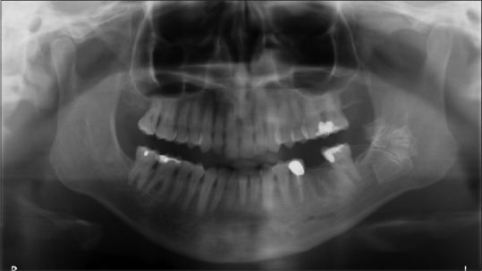Patient A. Initial presentation after extraction of #19. (Note Penrose drain in the left mandible)