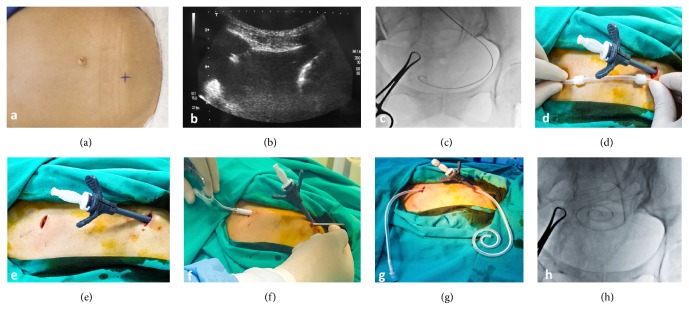 Operative technique. (a) Marking the entry site. (b) Accessing the intraperitoneal space with an 18G Chiba needle. (c) Fluoroscopic image showing advancement of the stiff guidewire to the most dependent place in pelvis. (d) Placing the peel-away sheath to the intraperitoneal cavity and determining the site of second incision line. (e) Making the second incision superolateral to the first incision. (f, g) Advancing the tunneling device through the tract with the catheter attached to its backside. (h) Fluoroscopic image showing placement of the catheter to the most dependent part of pelvis.