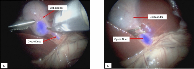 Swine #1—Images of the gallbladder neck and cystic duct during the first surgery before (a) and after (b) cystic duct clipping with BL-760 overlay